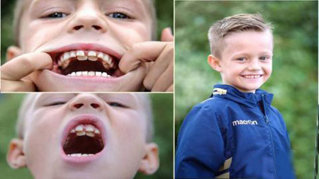 کودکی عجیبی که 300 دندان دارد! (عکس) 1