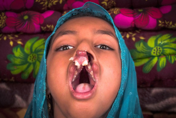 تصاویر عجیب و دردناک از بیماری این دختر 9 ساله ی ایرانی 1