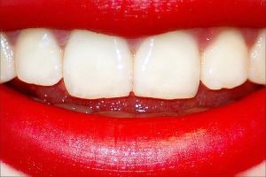 رابطه رنگ دندانها با بیماریها 1
