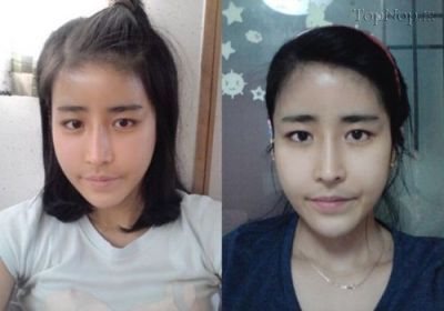 قبل و بعد از جراحی زیبایی در کره ی جنوبی 1